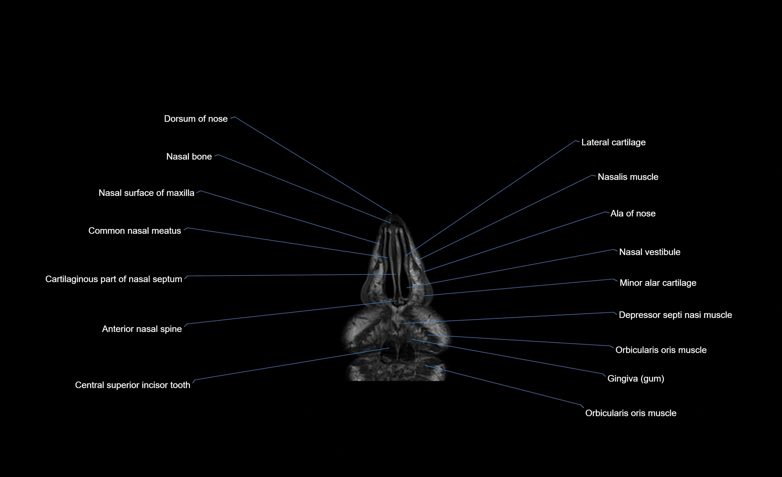 MRI face & paranasal sinuses(PNS) labelled  coronal  cross sectional anatomy 3T radiology  image-img-00001-00008.webp
